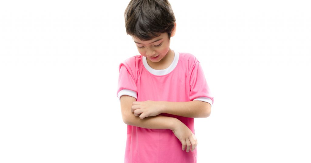 Treating Childhood Atopic Eczema